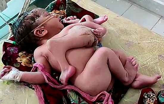 В Индии родился "чудо-ребенок"