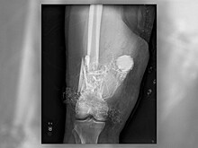 Хирурги удалили из бедра неразорвавшийся заряд фейерверка