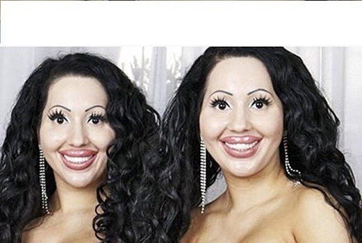 До и после: близняшки сделали идентичную пластику ради одного жениха — и над ними смеются