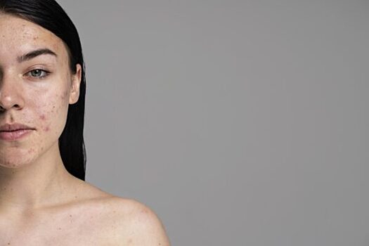О чем говорят высыпания на лице: разбиваем мифы о состоянии кожи