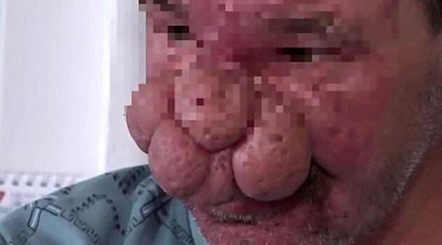 Пластические хирурги исправили мужчине клоунский нос