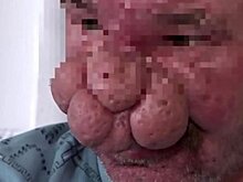 Пластические хирурги исправили мужчине клоунский нос