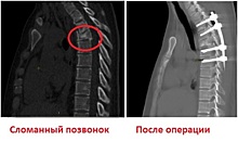 Врачи больницы Вересаева в САО спасли жизнь и сохранили здоровье женщине, упавшей с 12 этажа