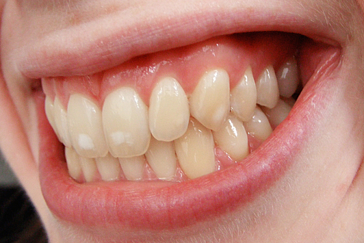 Флюороз: причины появления пятен на зубах и меры профилактики
