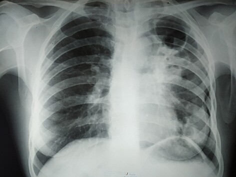 Год спустя: к чему привели фальшивые справки из Бежецкой ЦРБ для умершей от туберкулёза школьной медсестры