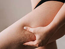 Pravda.Ru: стресс может спровоцировать появление целлюлита