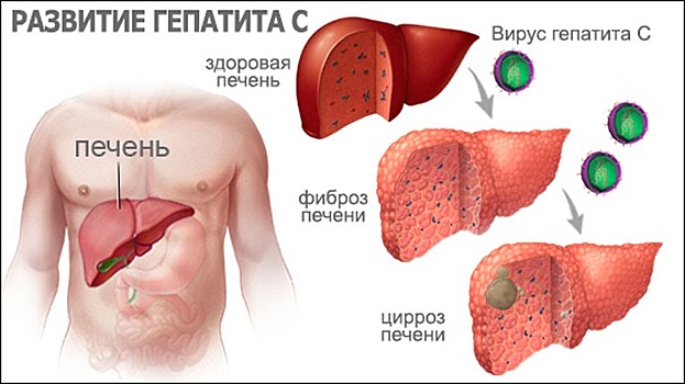 Чем грозит самостоятельное лечение гепатита