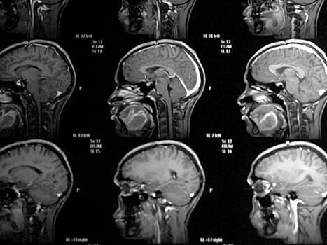 Ученые научились заменять поврежденные клетки мозга