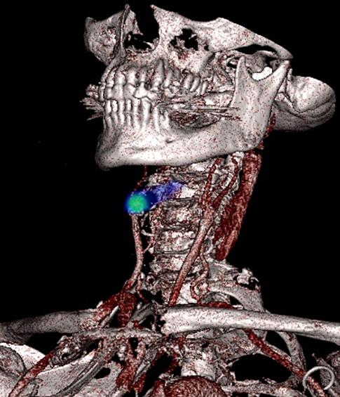 Закупорка (показан зеленым) одного из кровеносных сосудов (красный) на шее пациента. Снимок выполнен методами компьютерной и позитронно-эмиссионной томографии