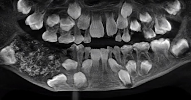 Врачи достали из челюсти семилетнего мальчика 526 зубов