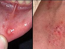 Сибирячка показала первый симптом вируса Коксаки у дочери