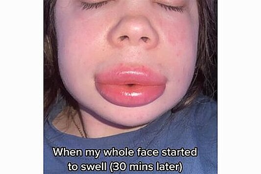 Девушка сэкономила на увеличении губ и потеряла способность говорить