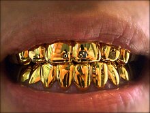 Стоматолог: золотые коронки имеют много негативных аспектов