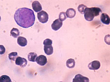 Найдено лекарство против агрессивного рака крови