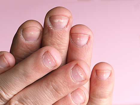 О чем сигнализируют белые полоски на ногтях