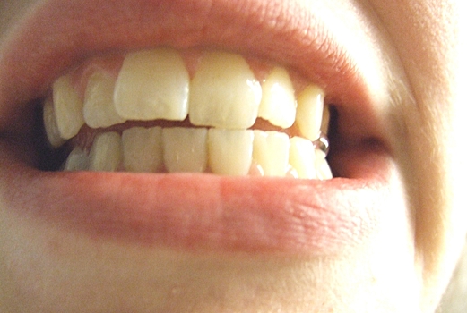 Как перестать сжимать зубы: четыре простых приема