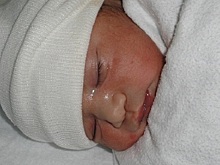 Выявлены первые случаи рождения детей с повреждениями мозга из-за коронавируса