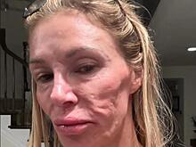 Популярная американская модель показала изуродованное из-за паразитов лицо: шокирующее фото