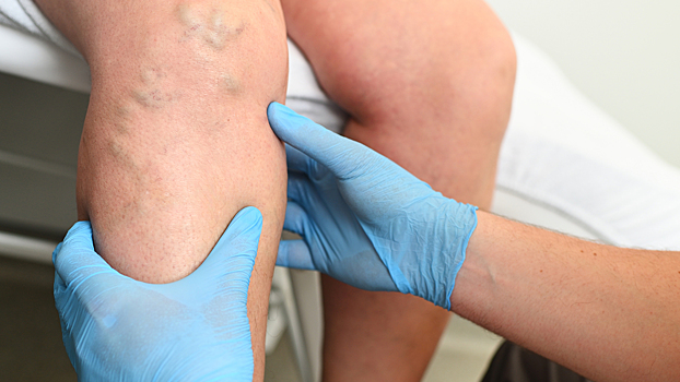 Хирург предостерёг: боль в ноге может закончиться тромбом в лёгком