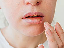 Впервые исследовано происхождение вируса герпеса на губах