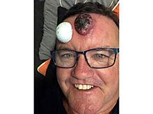 Мужчина принял опухоль за прыщ