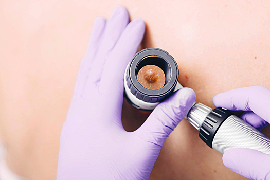 Папилломы: причины, диагностика, лечение