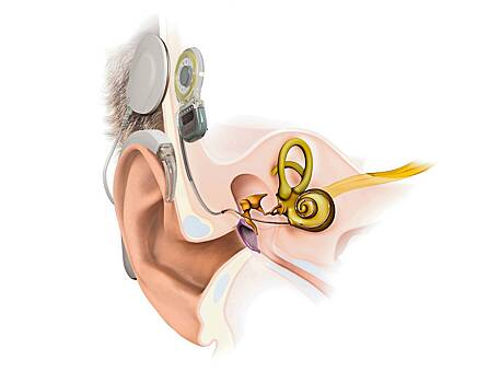 Кохлеарный имплантат – что это такое и для чего он служит?