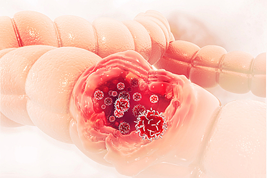 Врачи перечислили явные симптомы рака толстой кишки