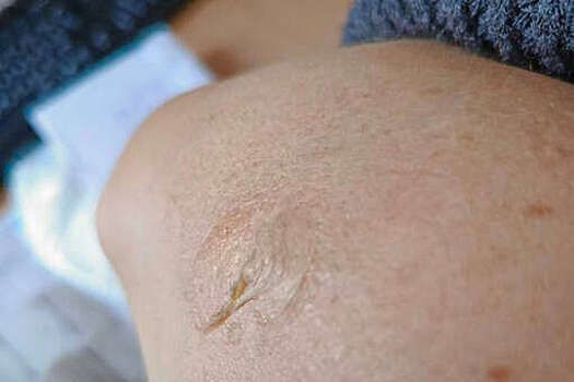 В Обнинске женщина получила ожог второй степени из-за полотенцесушителя