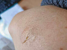 В Обнинске женщина получила ожог второй степени из-за полотенцесушителя