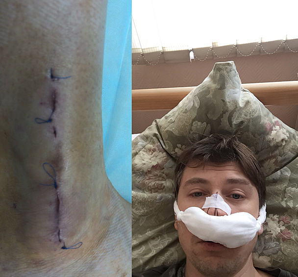 "Эту неделю мы с @tatianatotmyanina встретили по-семейному , в кругу близких. Таня провела уже 4ую операция на ноге, вытащили металическую конструкцию. А очищал голову от гноя, а то ещё чуть-чуть и ослеп бы или сдох короче, ТО у официалов пройдено. Обновления загружены Готовы к работе P.S. а как у вас началась неделя???", - написал Ягудин в своем Instagram