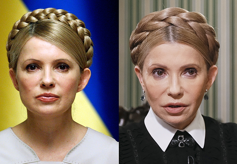 Украинский политик Юлия Тимошенко (до и после операции)