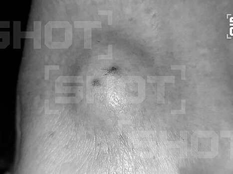 SHOT: большая шишка выросла у россиянки после укуса паука в Египте