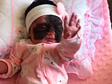 Младенца с черным родимым пятном на все лицо назвали монстром