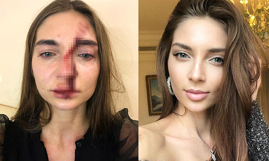 Модель и певицу из Новосибирска врачи избили в столичной косметологической клинике за уточняющие вопросы. Девушка показала в своем аккаунте Instagram видео, на котором она продемонстрировала сломанный нос и окровавленное лицо. Об этом сообщает РЕН-ТВ.