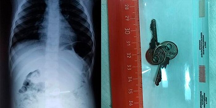 Столичные врачи вытащили ключи из желудка ребенка