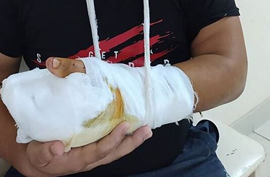 Операция длилась 10 часов: в Ростове врачи пришили отрубленную кисть 25-летнему пациенту
