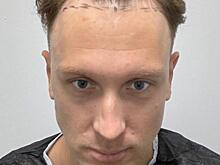 T-Killah сделал операцию по трансплантации волос и поделился кадрами из стамбульской клиники: «Выглядит очень страшно»