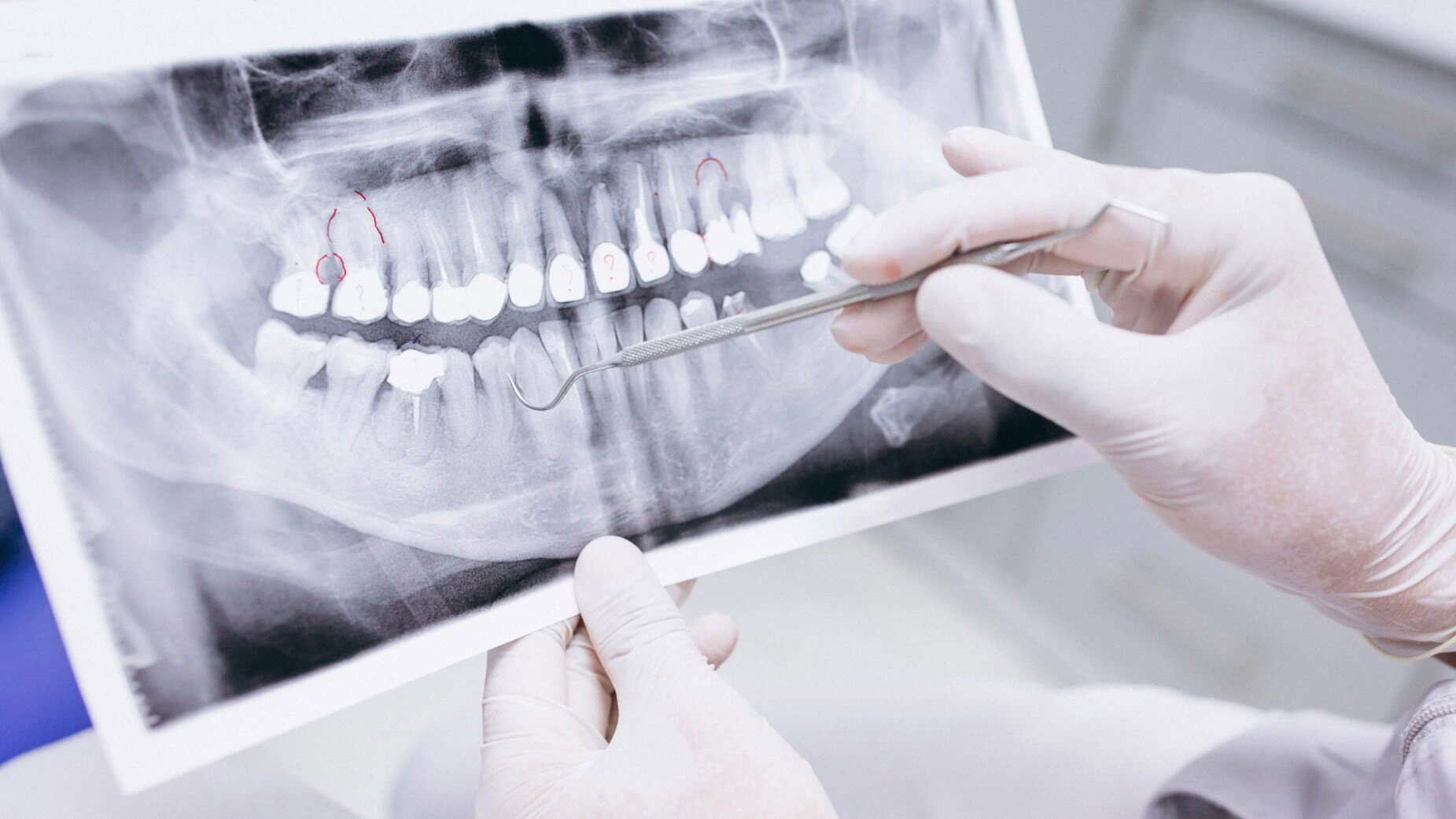 Потеря зубов связана с лишним весом