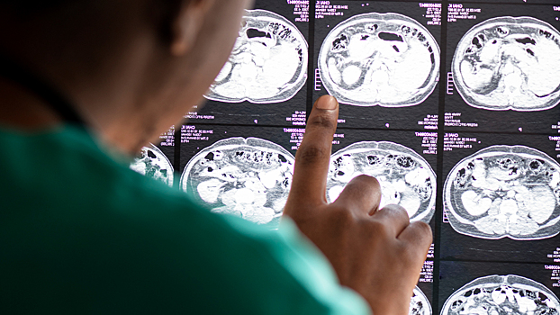 По каким симптомам можно выявить опухоль мозга