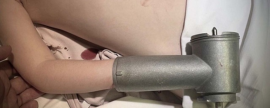 В Воронеже 3-летнему мальчику спасли руку, попавшую в электромясорубку