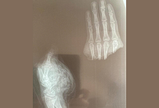 Московские врачи пришили пациенту отпиленные случайно пальцы