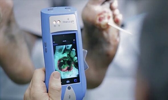 Ручной сканер MolecuLight i:X позволяет увидеть бактерий в открытой ране