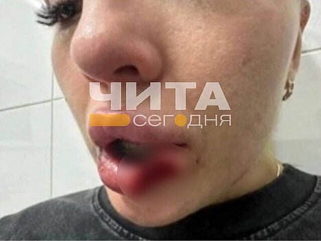Девушка в Чите попала в больницу без кусочка губы