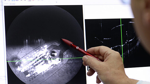 Проведена операция по установке бионического глаза