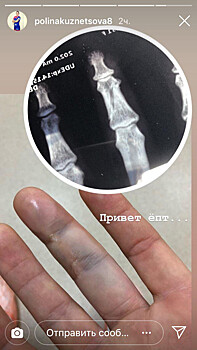 Кузнецова опубликовала снимок пальца, повреждённого в финале ЧЕ