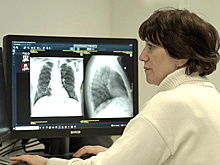 Работа нейросетей в медицине включена в систему ОМС