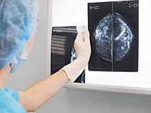 ИИ помог довести выявление рака груди на ранних стадиях до 80%