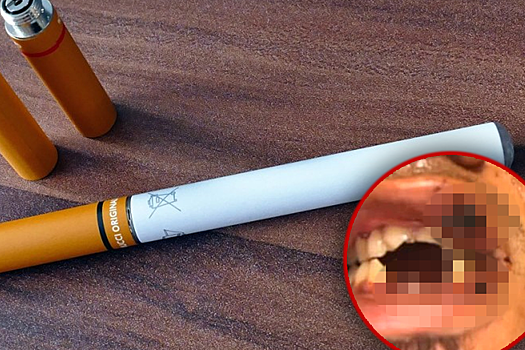 Лишиться зубов из-за электронной сигареты