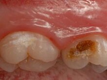 Ученые обнаружили бактерии, которые ускоряют процесс распада зубов